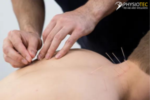 Acupuncture Services in Brantford